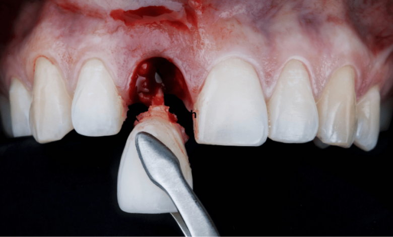 How Long Does It Take to Recover From a Tooth Extraction?